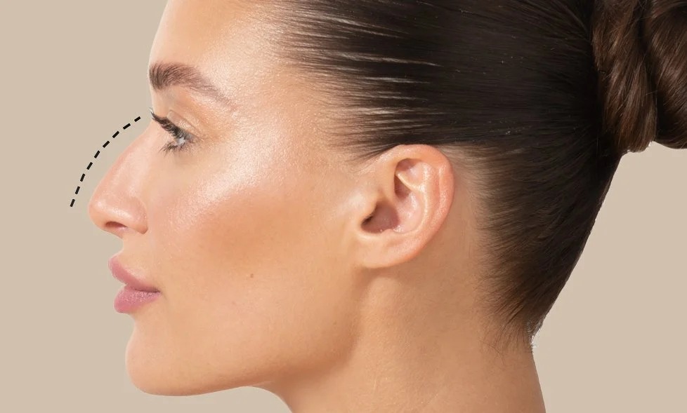 Rhinoplasty in Dubai