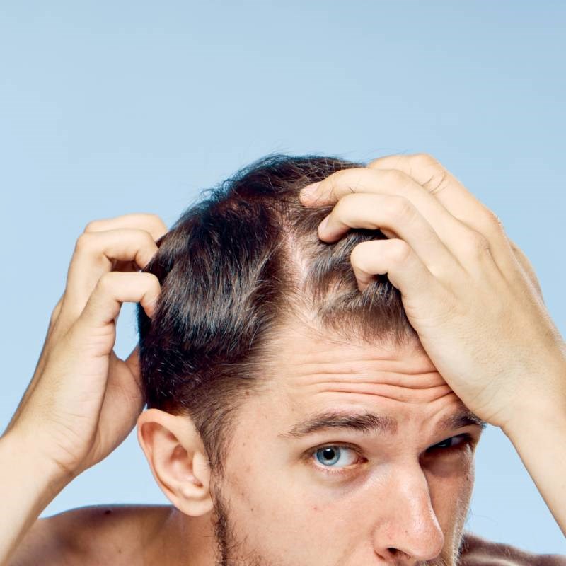 Hair Replacement in Dubai