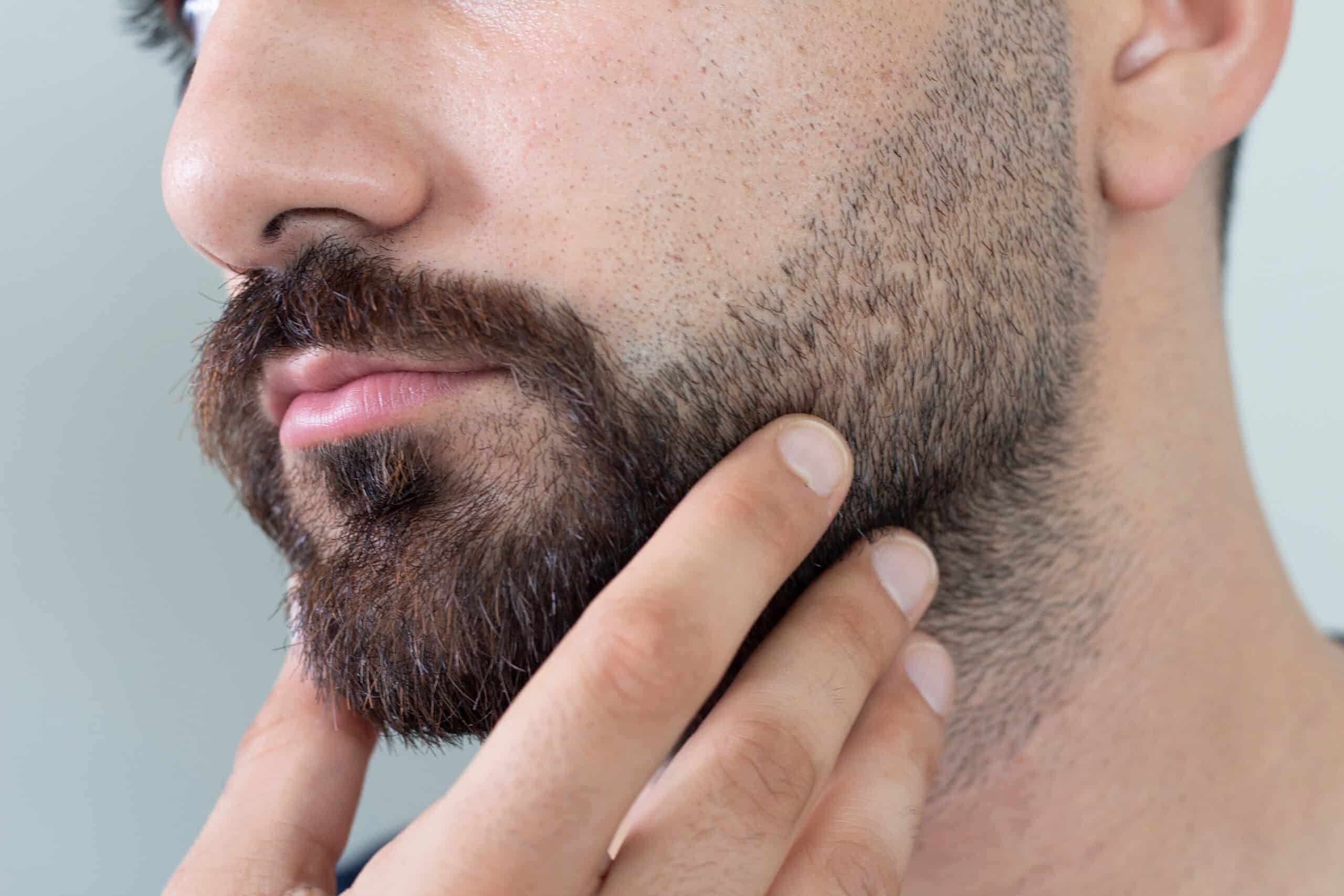 Beard Hair Transplant in Dubai