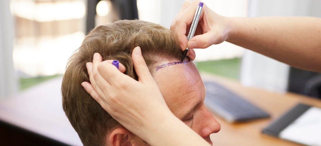Selecting Suitable Grafts for Hair Transplant in Dubai